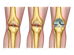 Degenerative Arthritis (Osteoarthritis)