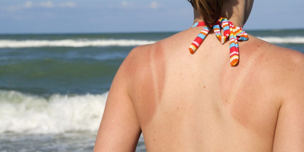 UV rays—beyond sunburn